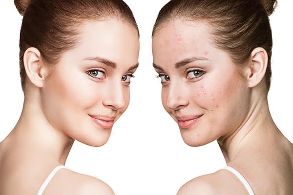 Managing Teen Acne the Right Way