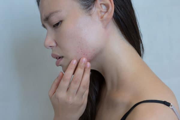 Is Your Skincare Causing Breakouts?