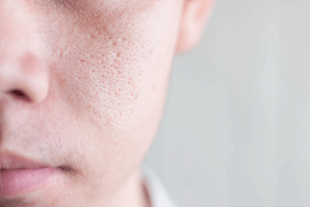 Poring Over Pores